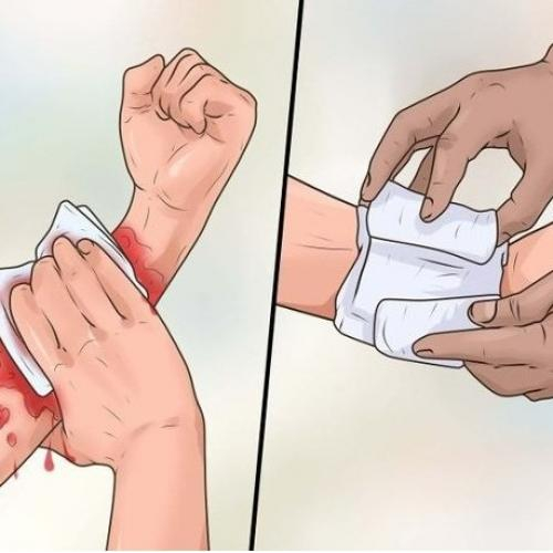 Bài 2c: Các trường hợp sơ cứu thường gặp: Cầm máu
