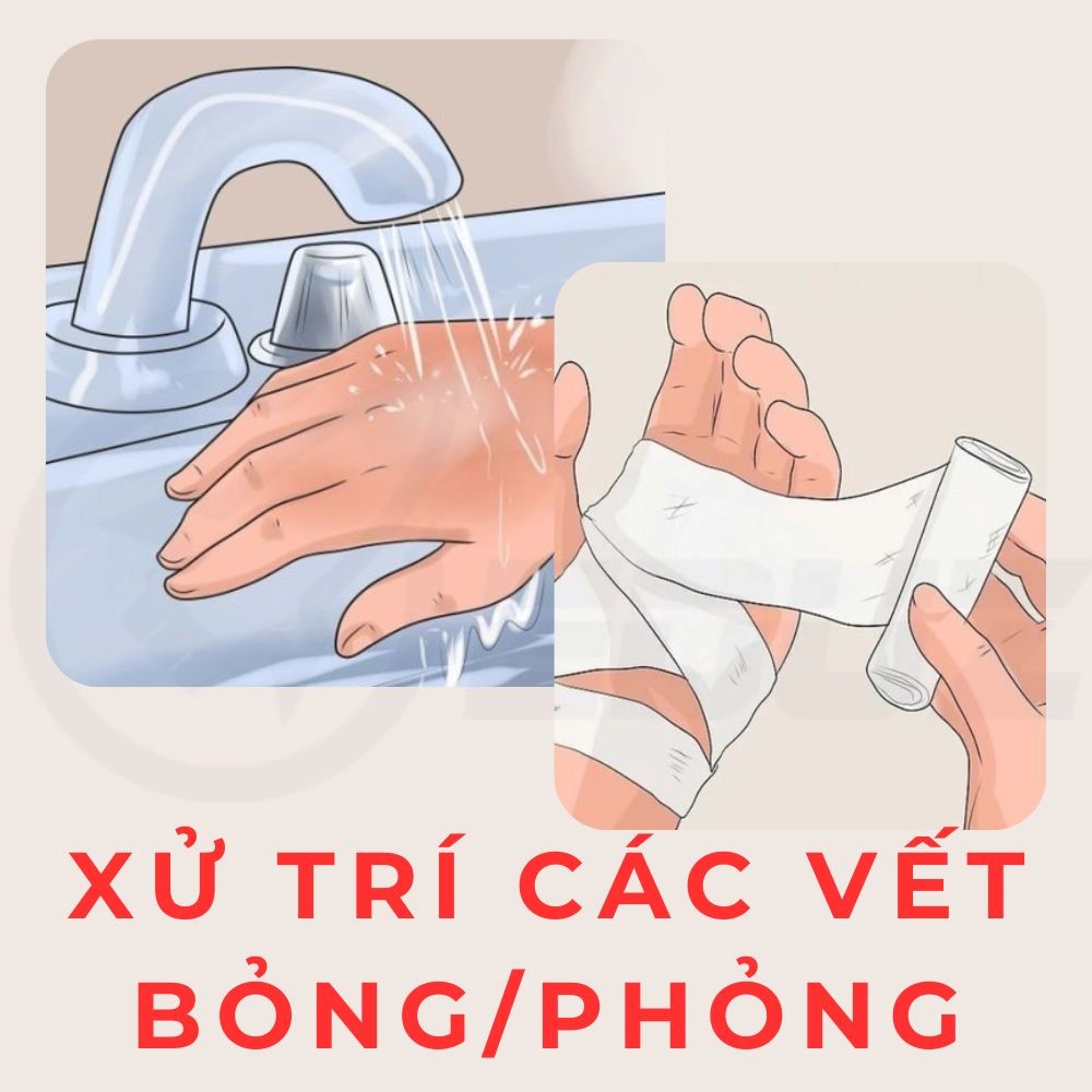 Xử Trí Các Vết Bỏng / Phỏng