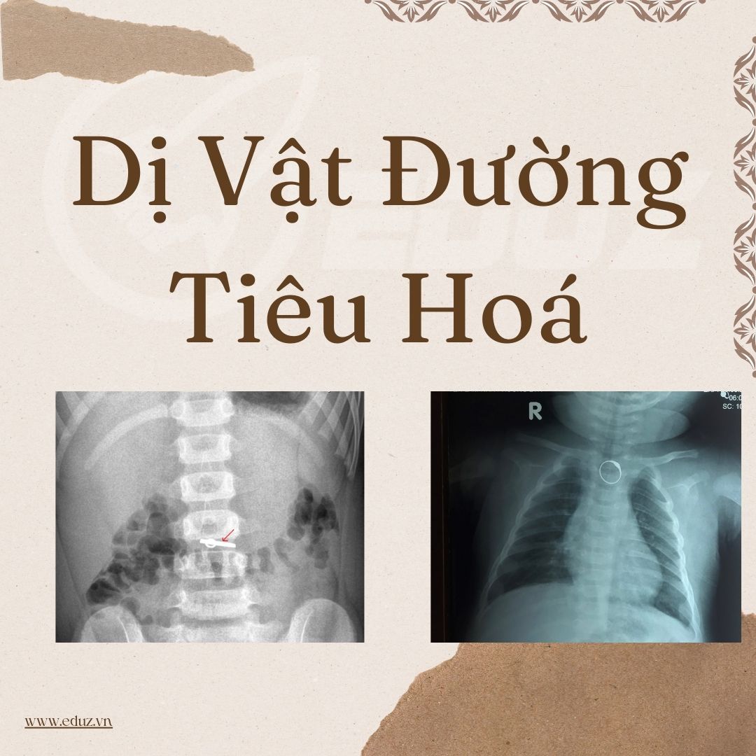 Dị Vật Đương Tiêu Hoá