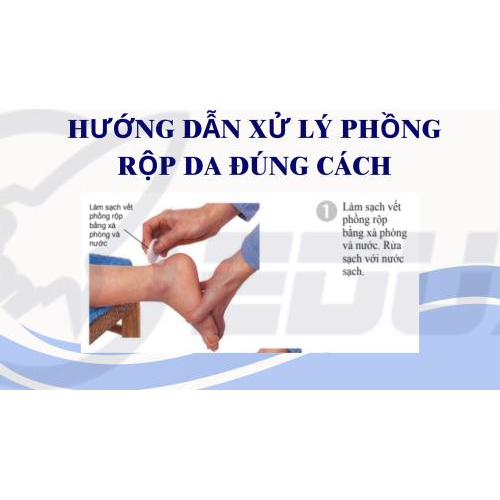 2. Hướng Dẫn Xử Lý Phồng Rộp Da Đúng Cách