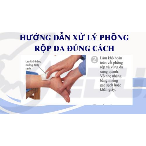 2. Hướng Dẫn Xử Lý Phồng Rộp Da Đúng Cách