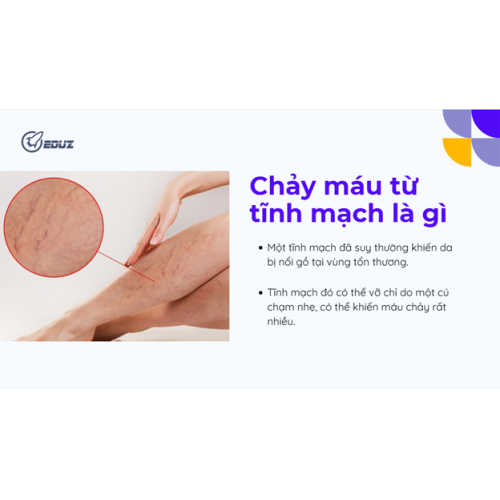 1. Chảy máu từ tĩnh mạch là gì? Nguyên nhân từ đâu