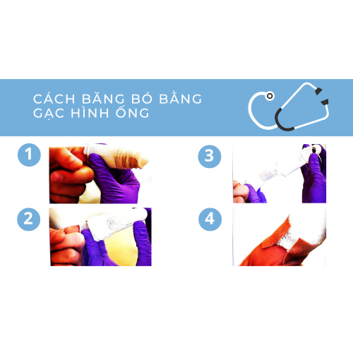 1.1. Cách băng bó bằng gạc hình ống: