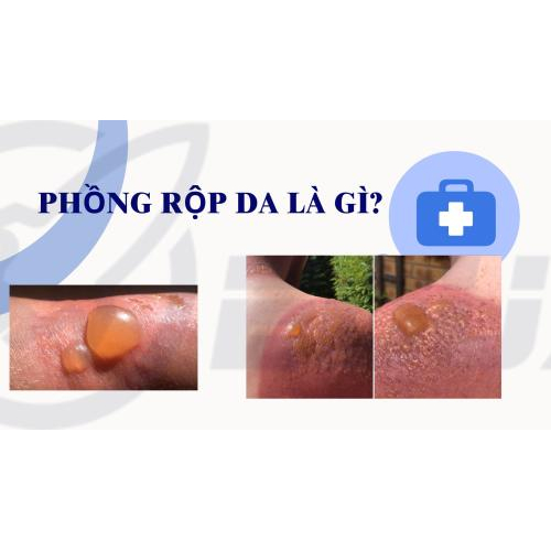 1. Phồng Rộp Da Là Gì?