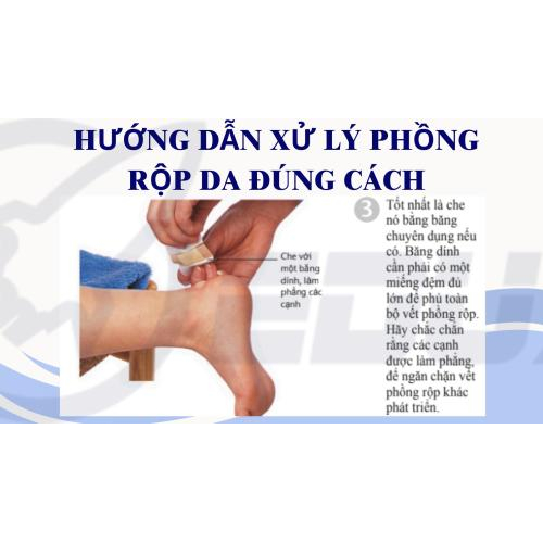 2. Hướng Dẫn Xử Lý Phồng Rộp Da Đúng Cách