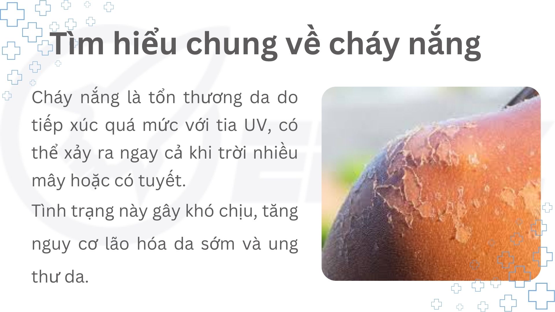 1. Tổng quan về cháy nắng