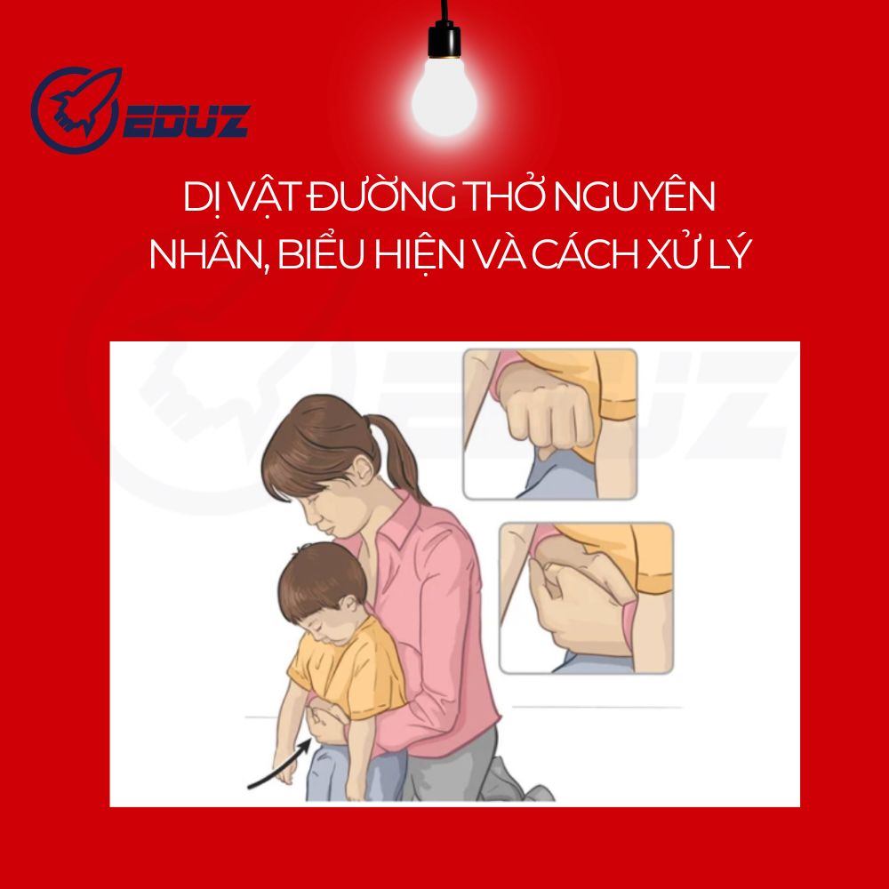 Dị Vật Đường Thở: Nguyên Nhân, Biểu Hiện Và Cách Xử Lý