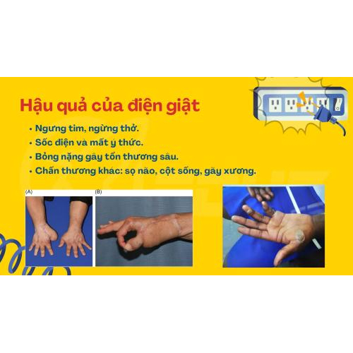 3. Hậu quả của điện giật