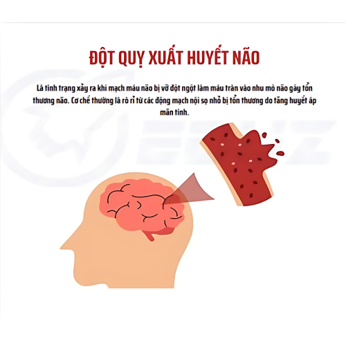 ĐỘT QUỴ XUẤT HUYẾT NÃO: