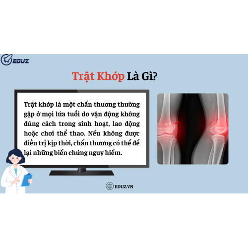 1. Trật Khớp Là Gì?